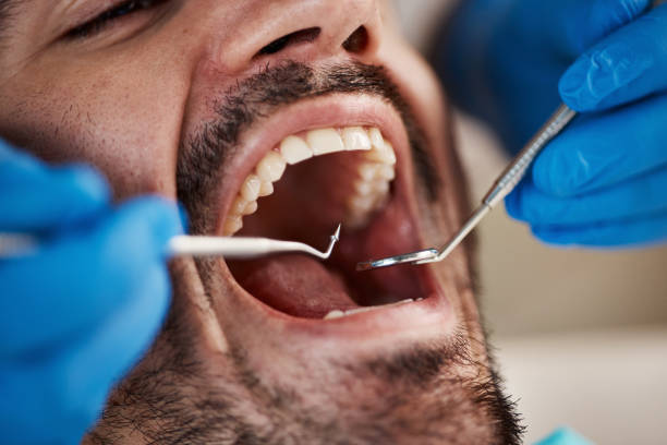 Best Emergency Tooth Extraction in Ivanhoe, CA